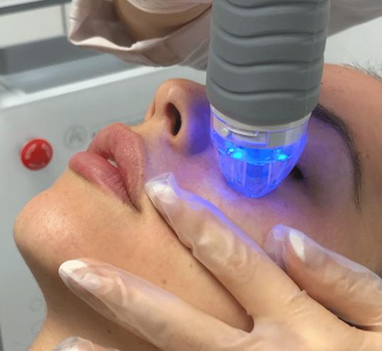 microneedling-with-radiofrequency-big