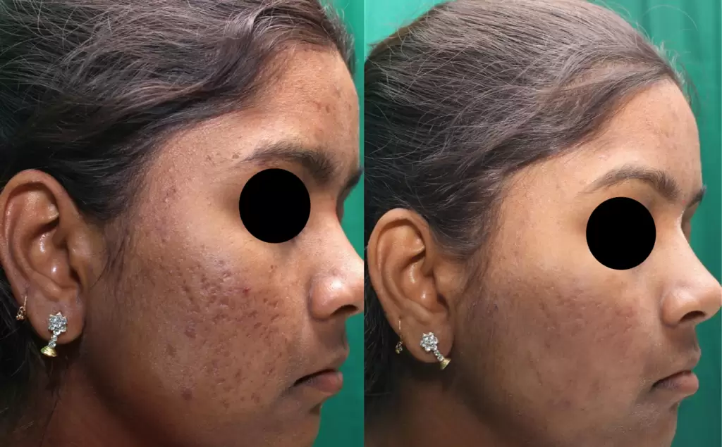 microneedling in Wildomar​