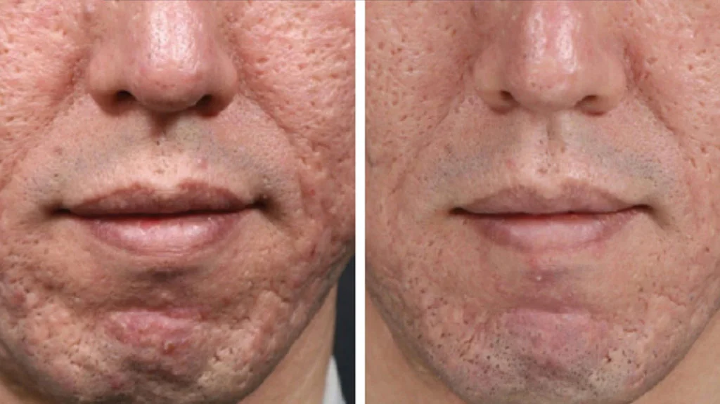 microneedling in Wildomar​