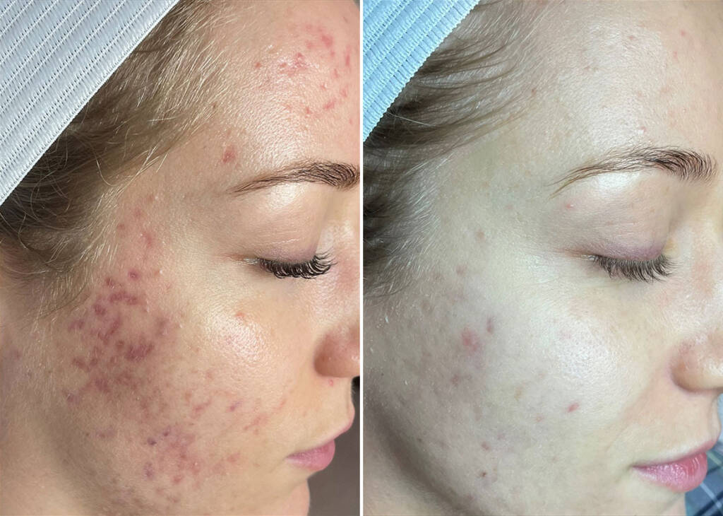 microneedling in Wildomar​