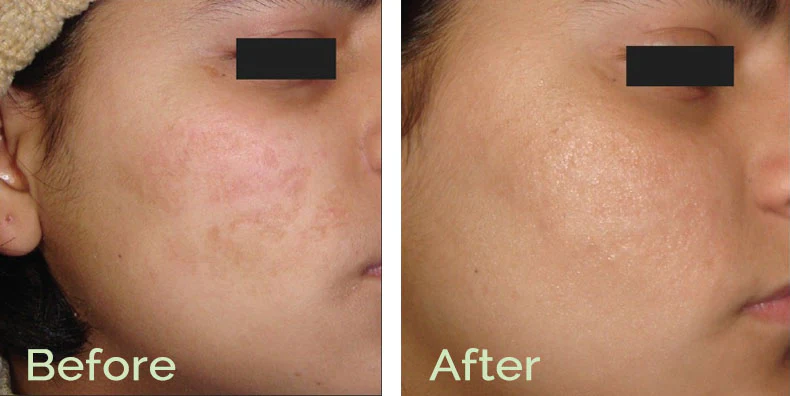 microneedling in La Cresta