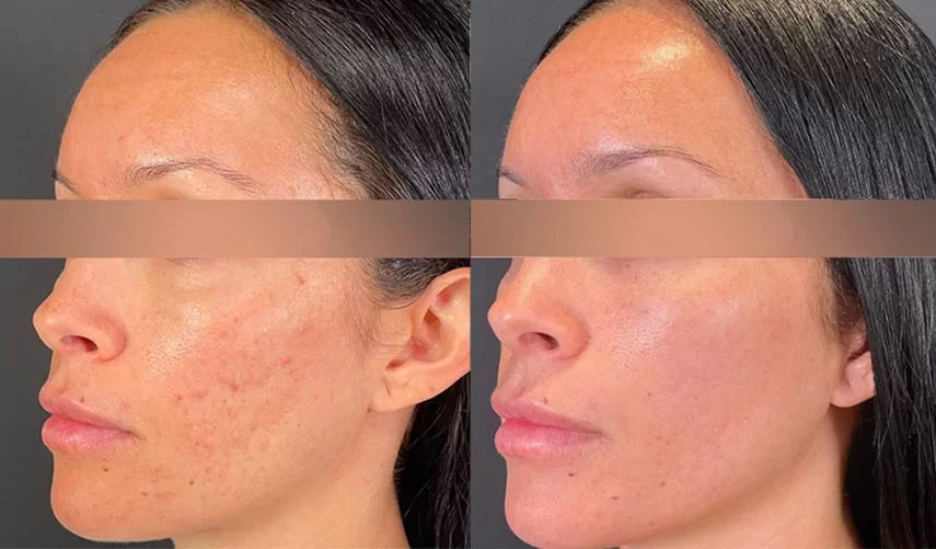 Microneedling in Temecula