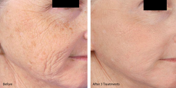 microneedling in La Cresta