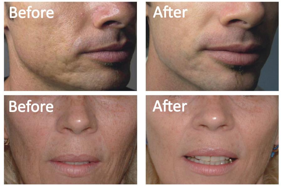 microneedling in Murrieta​