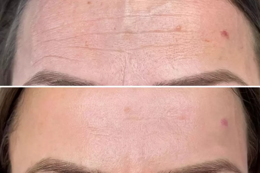 Microneedling in Temecula