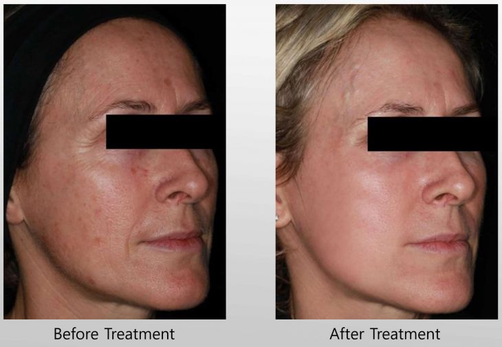 Microneedling in Fallbrook