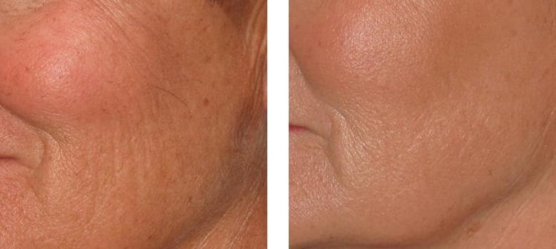 Microneedling in Fallbrook