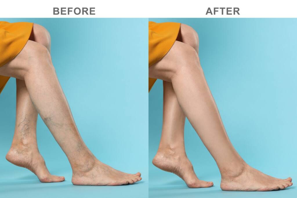 Varicose Veins